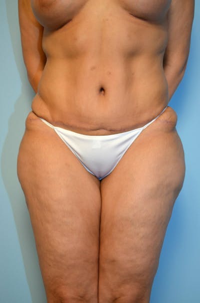 Tummy Tuck Before & After Gallery - Patient 200499 - Image 2