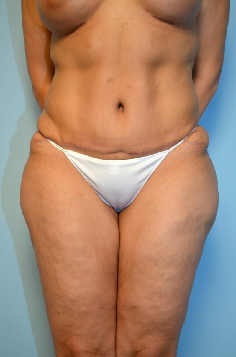 Tummy Tuck Before & After Gallery - Patient 200499 - Image 2