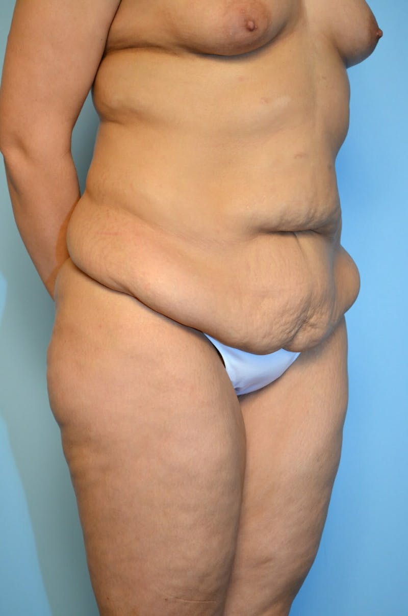 Tummy Tuck Before & After Gallery - Patient 200499 - Image 3