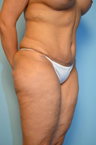 Tummy Tuck Before & After Gallery - Patient 200499 - Image 4