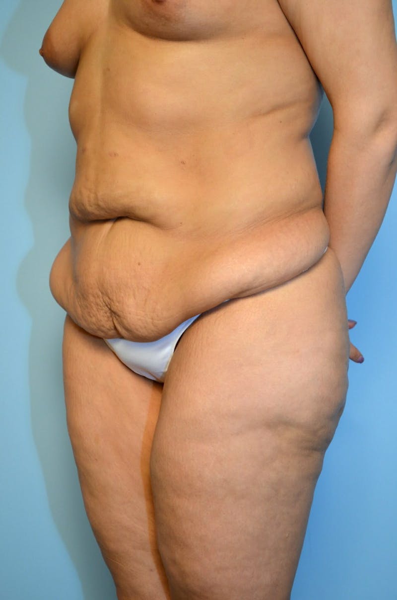 Tummy Tuck Before & After Gallery - Patient 200499 - Image 7