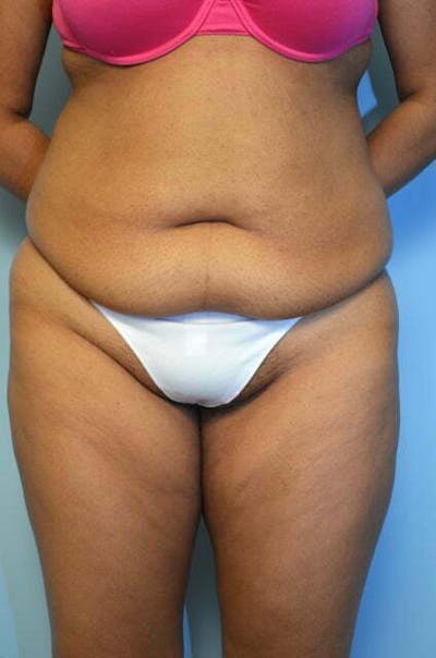 Liposuction Before & After Gallery - Patient 356653 - Image 1