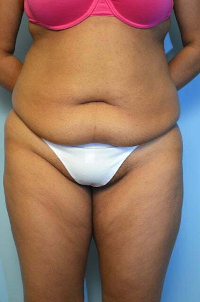 Tummy Tuck Before & After Gallery - Patient 546391 - Image 1
