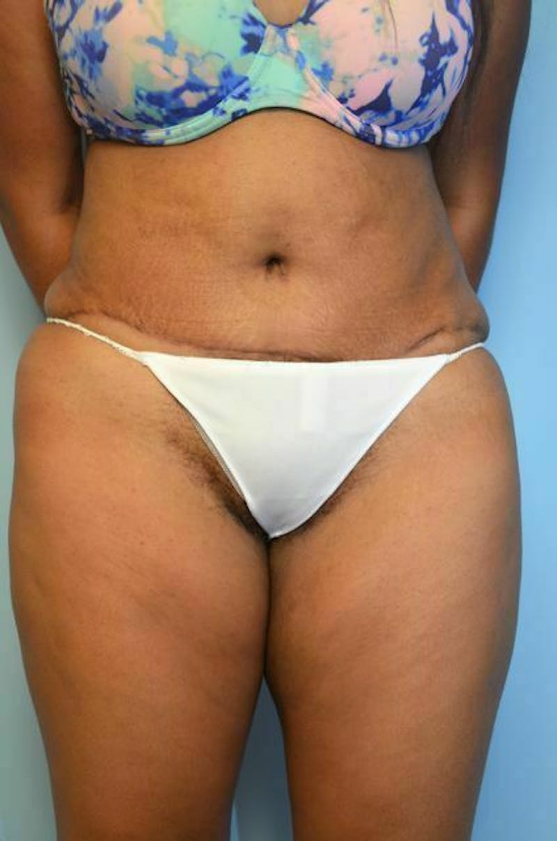 Tummy Tuck Before & After Gallery - Patient 546391 - Image 2