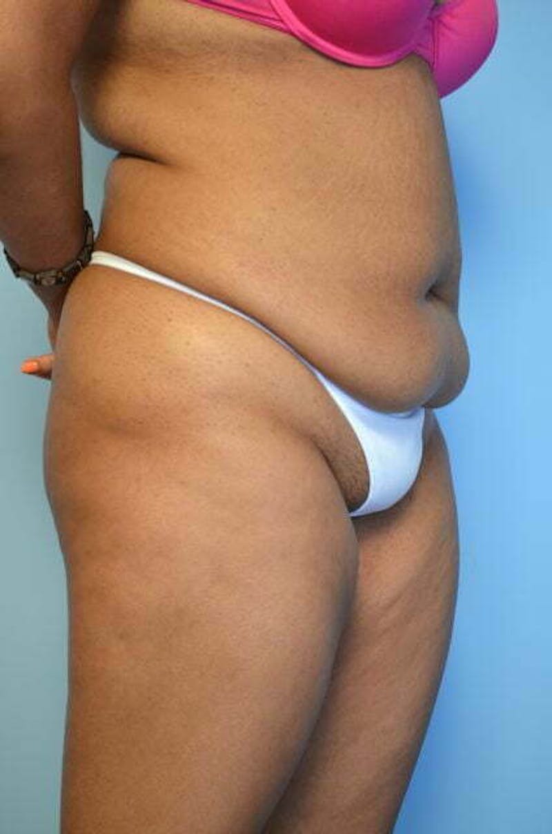 Tummy Tuck Before & After Gallery - Patient 546391 - Image 3