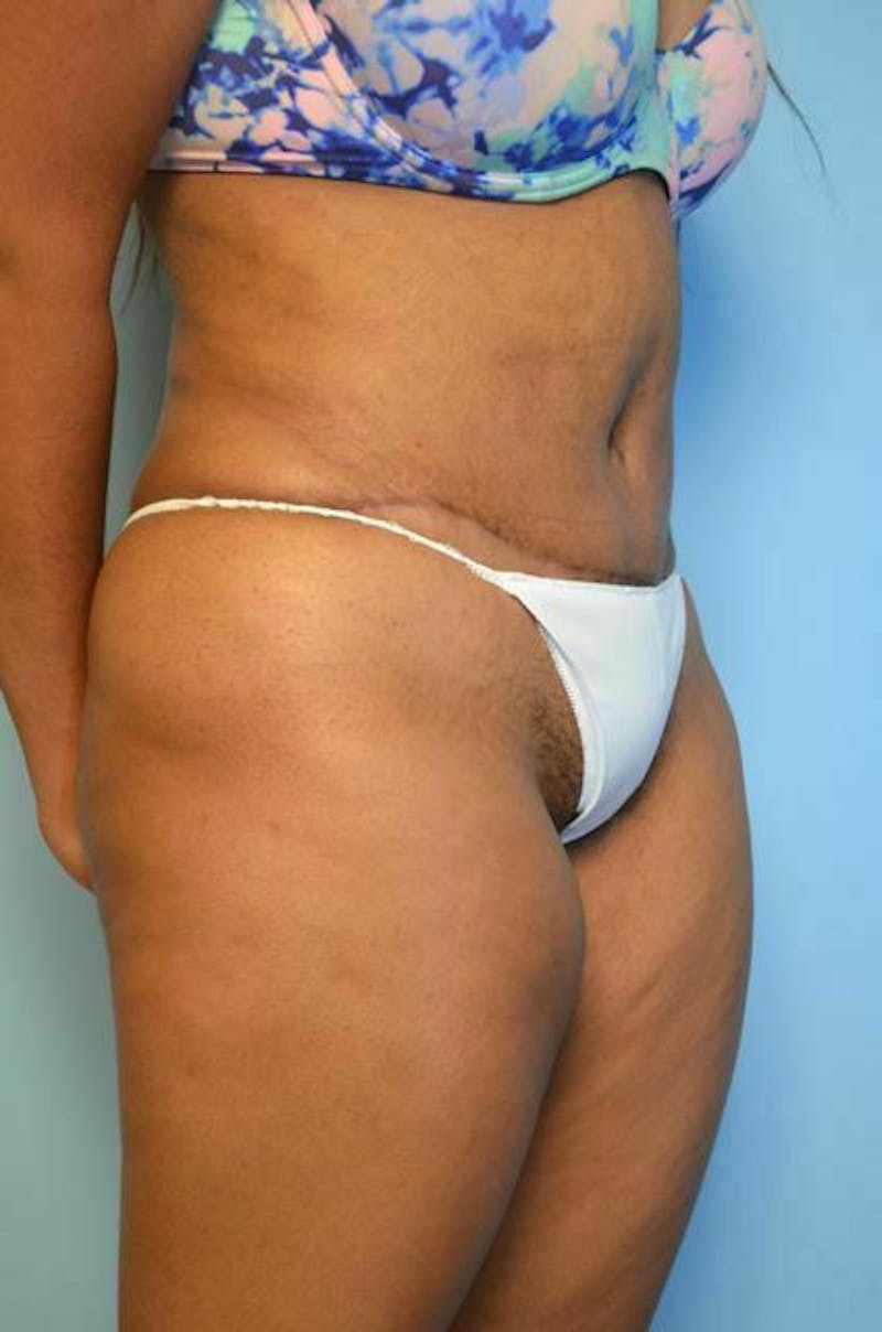 Tummy Tuck Before & After Gallery - Patient 546391 - Image 4