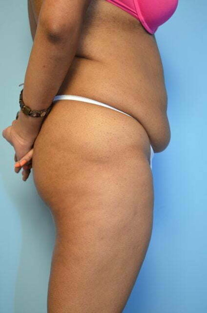 Tummy Tuck Before & After Gallery - Patient 546391 - Image 5