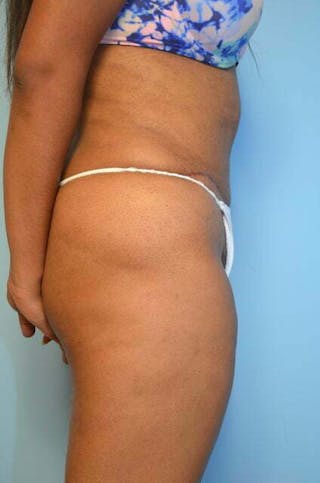 Liposuction Before & After Gallery - Patient 356653 - Image 6