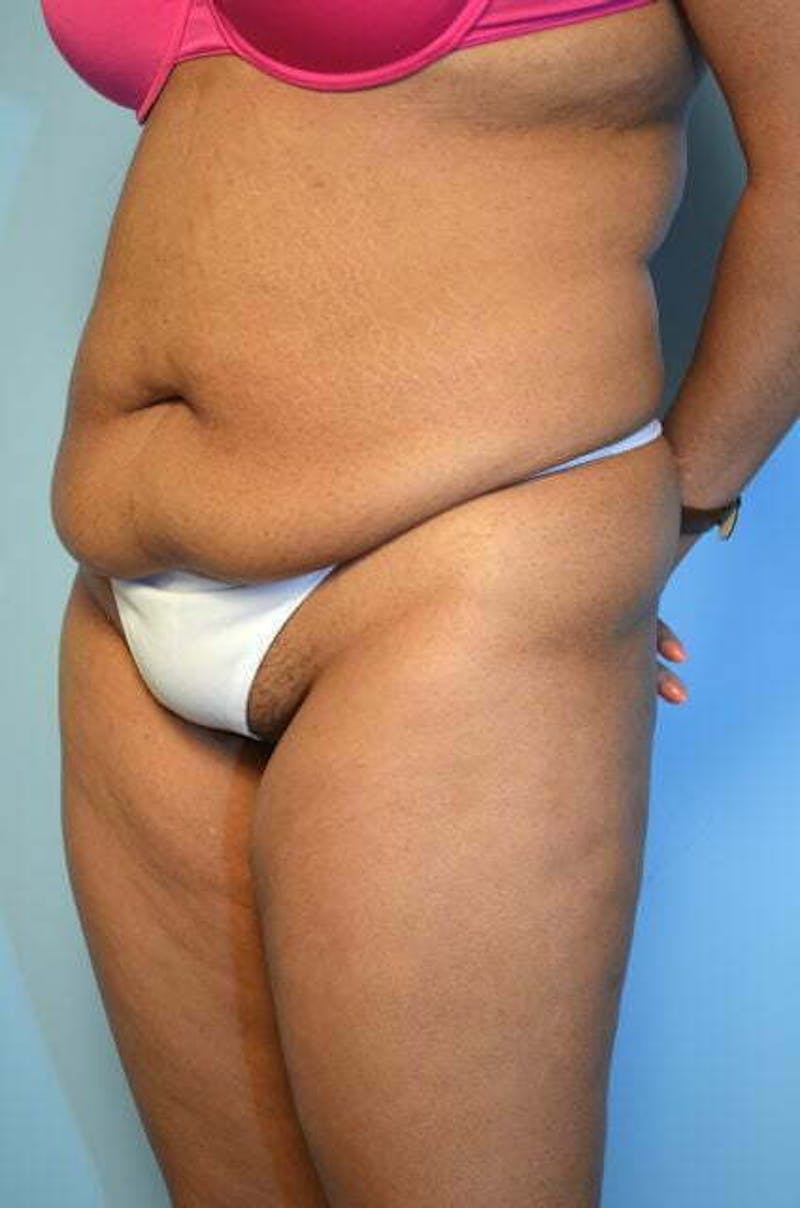 Tummy Tuck Before & After Gallery - Patient 546391 - Image 7