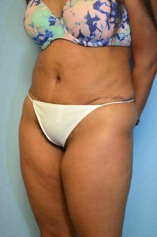 Liposuction Before & After Gallery - Patient 356653 - Image 8
