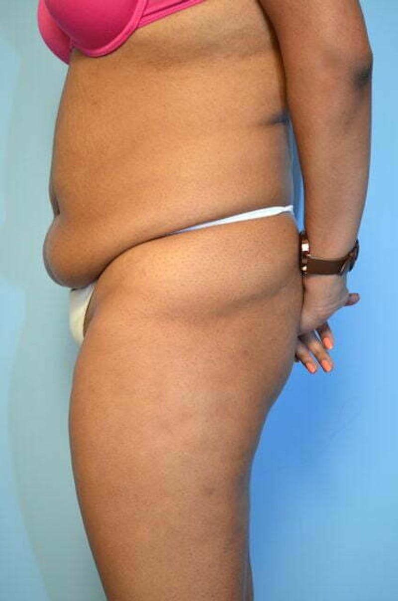 Tummy Tuck Before & After Gallery - Patient 546391 - Image 9
