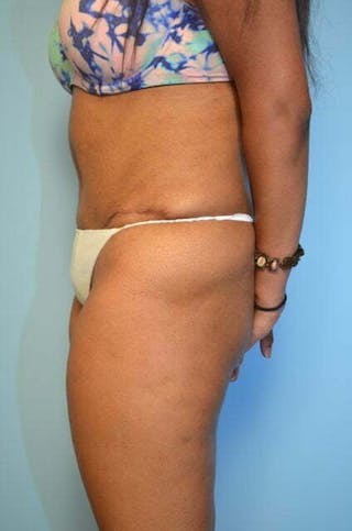 Liposuction Before & After Gallery - Patient 356653 - Image 10