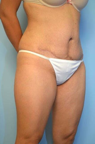 Tummy Tuck Before & After Gallery - Patient 230694 - Image 4