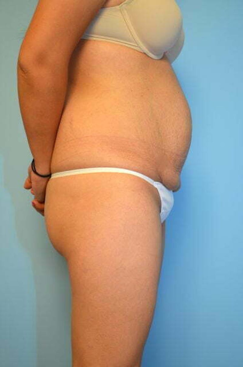 Tummy Tuck Before & After Gallery - Patient 230694 - Image 5