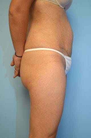 Tummy Tuck Before & After Gallery - Patient 230694 - Image 6