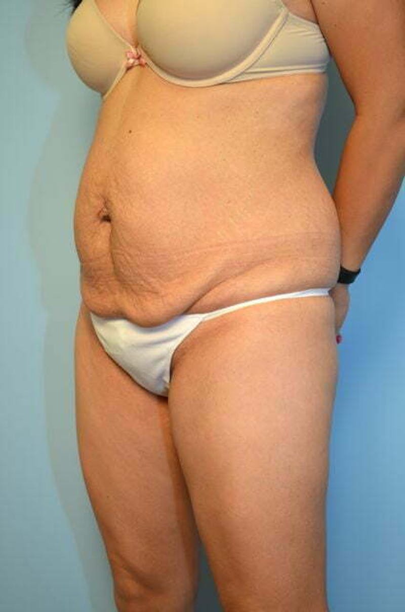 Tummy Tuck Before & After Gallery - Patient 230694 - Image 7