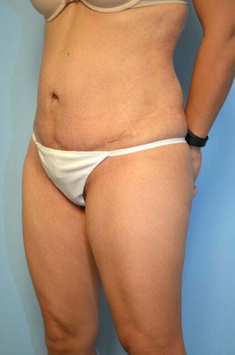Tummy Tuck Before & After Gallery - Patient 230694 - Image 8