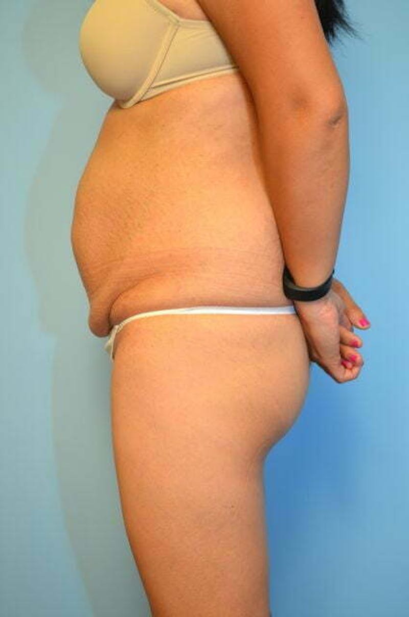 Tummy Tuck Before & After Gallery - Patient 230694 - Image 9