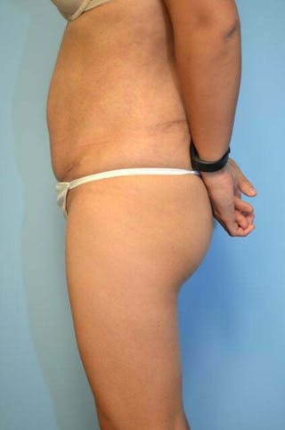 Tummy Tuck Before & After Gallery - Patient 230694 - Image 10