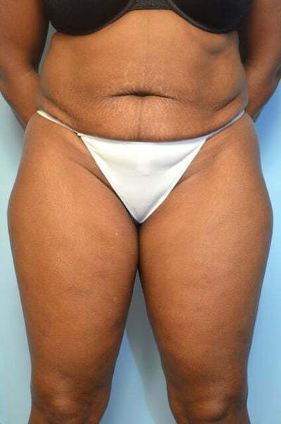 Liposuction Before & After Gallery - Patient 126762 - Image 1