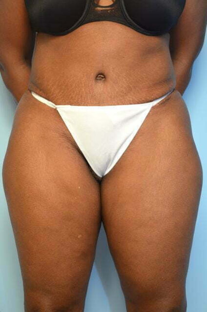 Liposuction Before & After Gallery - Patient 126762 - Image 2
