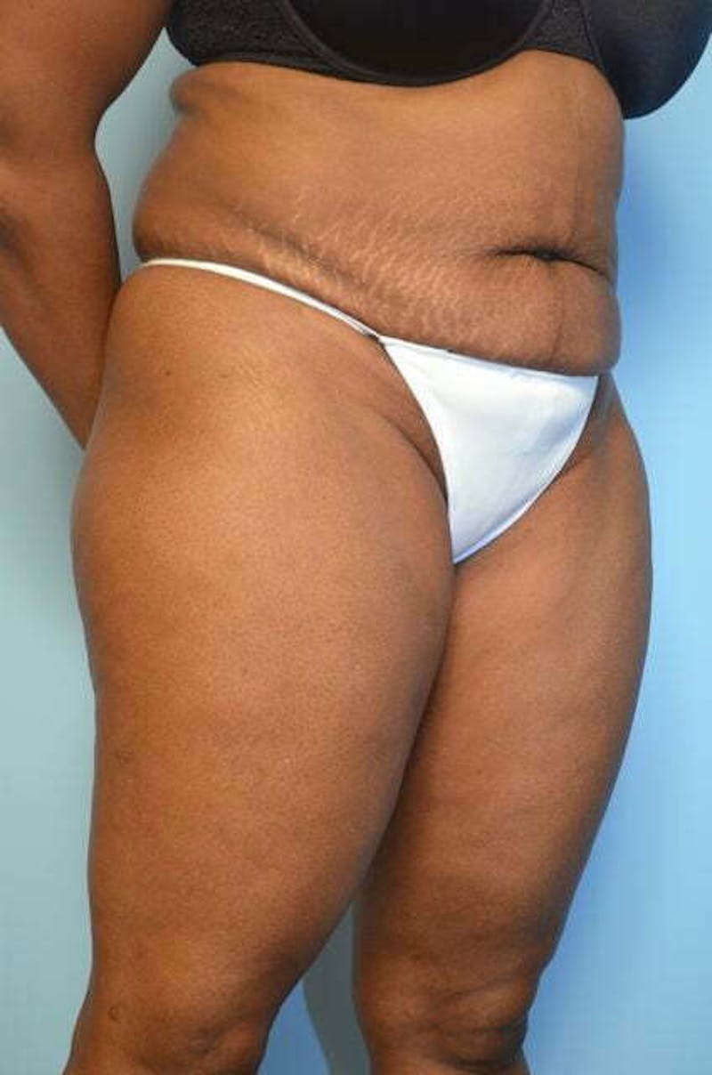 Liposuction Before & After Gallery - Patient 126762 - Image 3