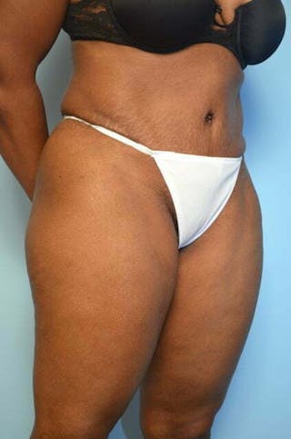 Liposuction Before & After Gallery - Patient 126762 - Image 4