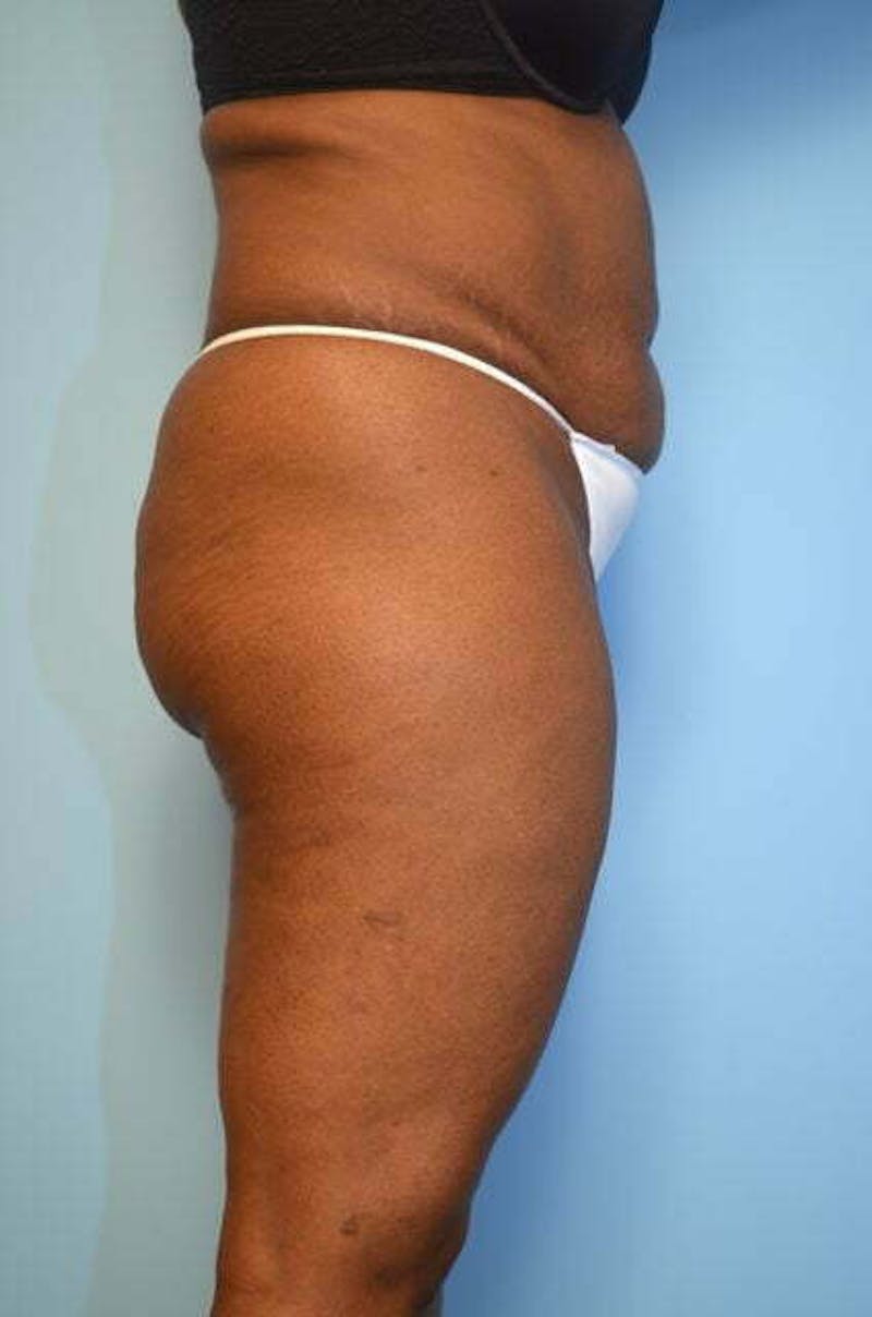 Liposuction Before & After Gallery - Patient 126762 - Image 5