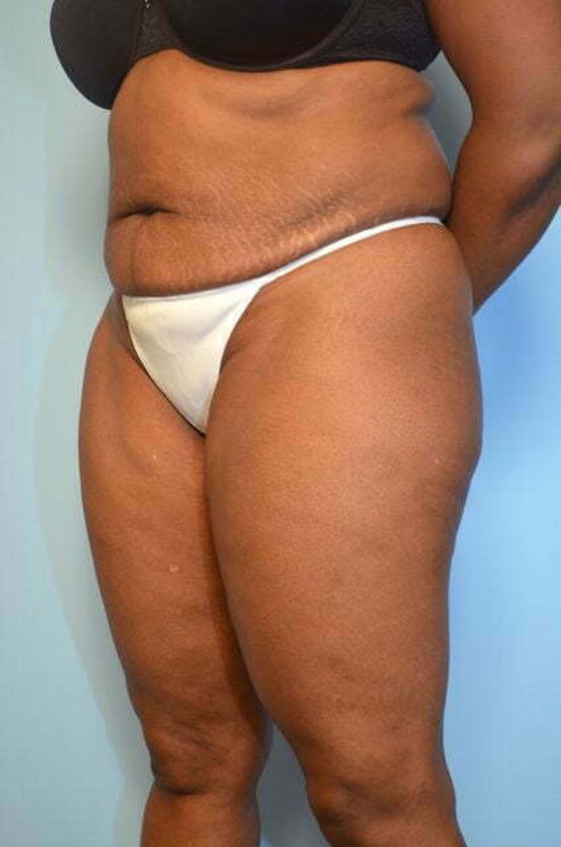 Liposuction Before & After Gallery - Patient 126762 - Image 7