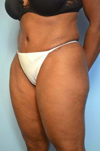 Liposuction Before & After Gallery - Patient 126762 - Image 8