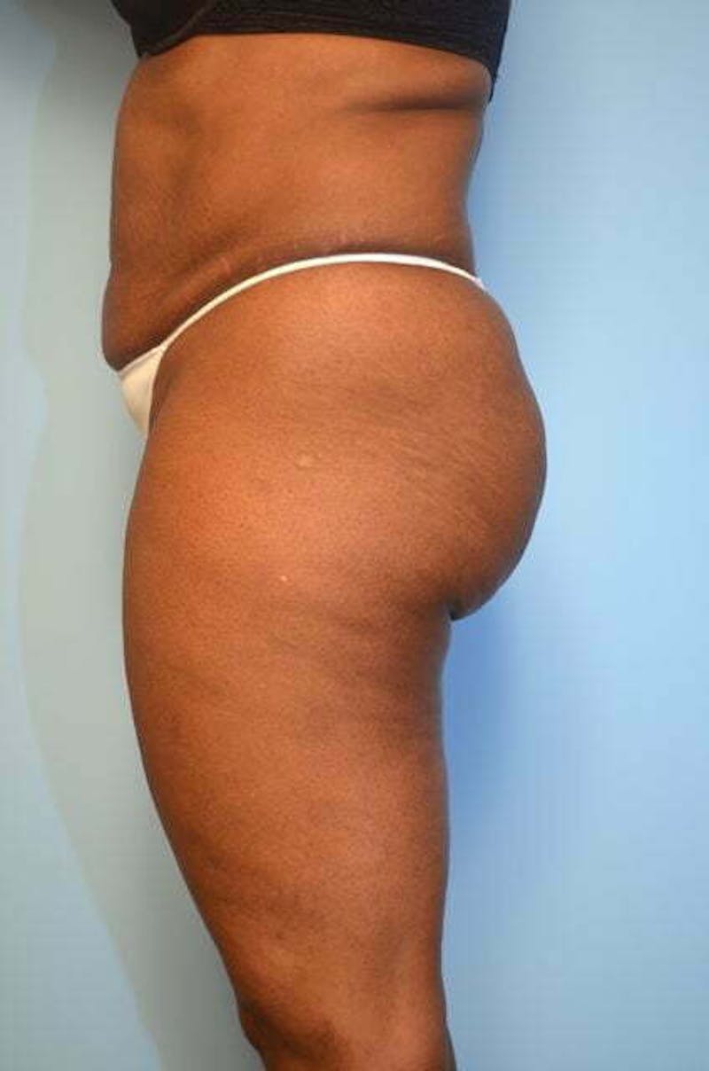 Liposuction Before & After Gallery - Patient 126762 - Image 9
