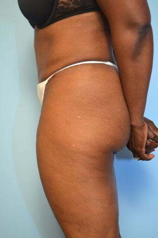 Liposuction Before & After Gallery - Patient 126762 - Image 10