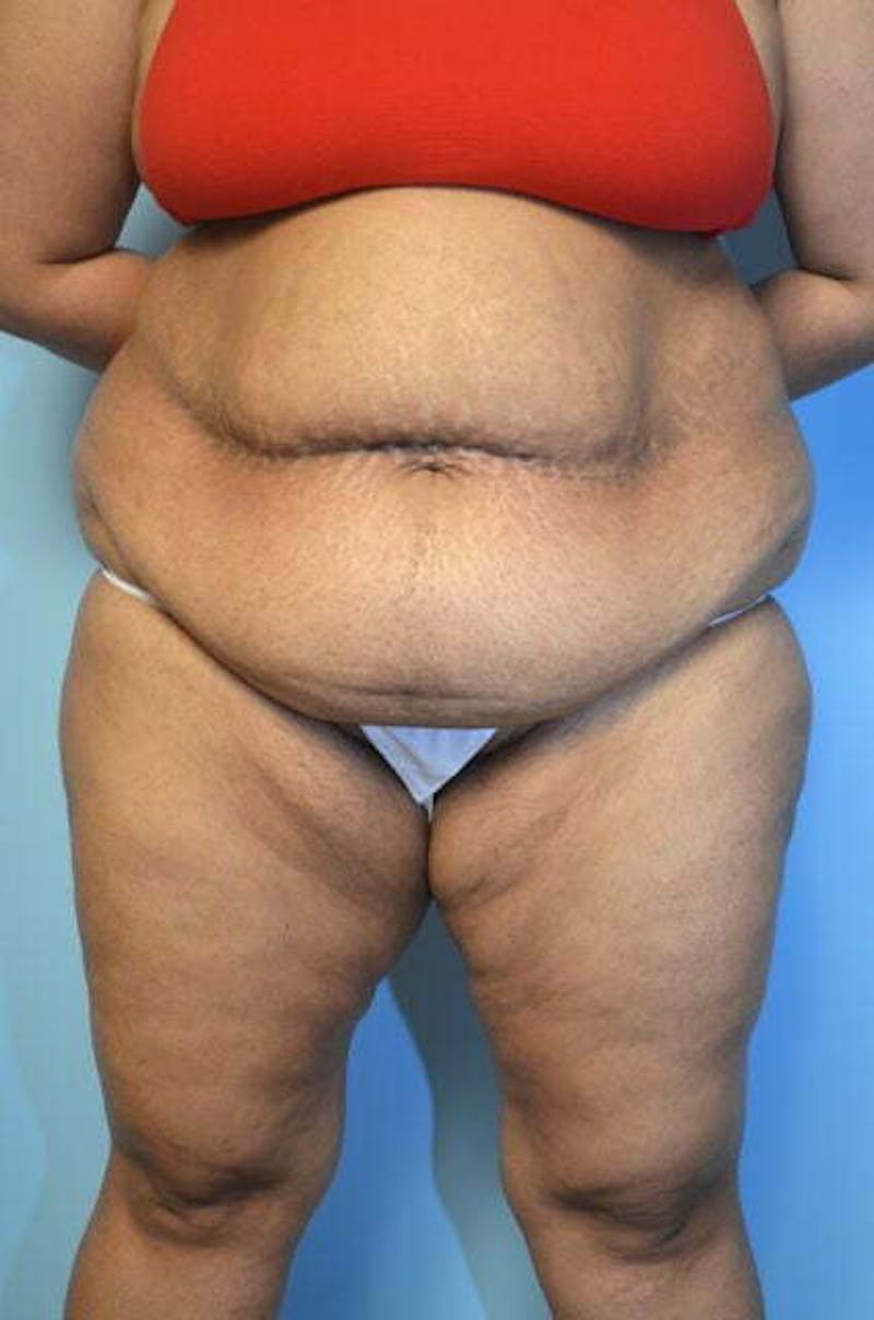 Liposuction Before & After Gallery - Patient 363518 - Image 1