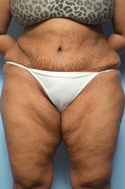 Liposuction Before & After Gallery - Patient 363518 - Image 2