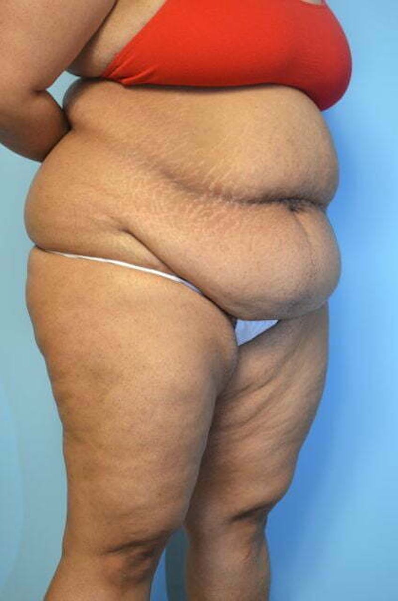 Liposuction Before & After Gallery - Patient 363518 - Image 3