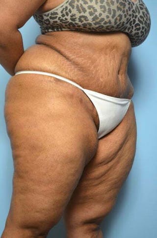 Tummy Tuck Before & After Gallery - Patient 276801 - Image 4