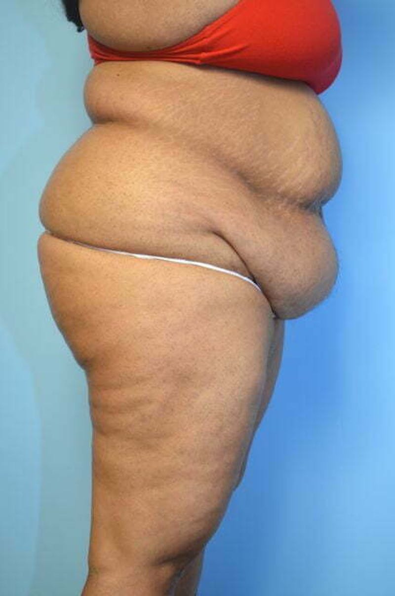 Liposuction Before & After Gallery - Patient 363518 - Image 5