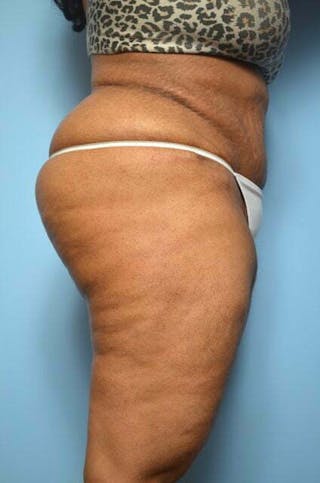Tummy Tuck Before & After Gallery - Patient 276801 - Image 6