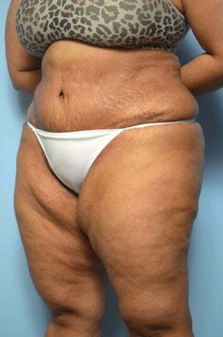 Tummy Tuck Before & After Gallery - Patient 276801 - Image 8