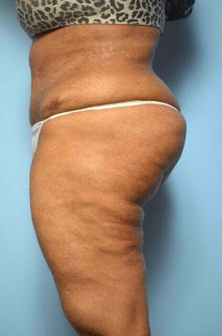 Tummy Tuck Before & After Gallery - Patient 276801 - Image 10