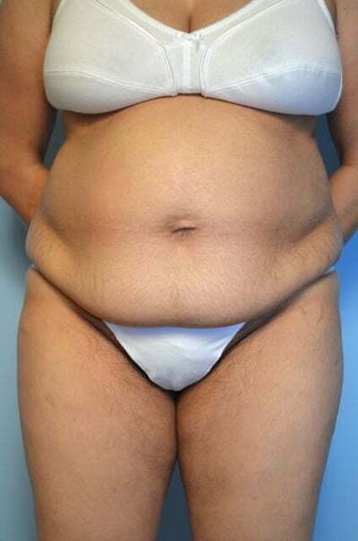 Liposuction Before & After Gallery - Patient 286088 - Image 1