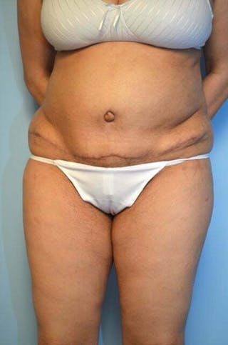 Tummy Tuck Before & After Gallery - Patient 239638 - Image 2