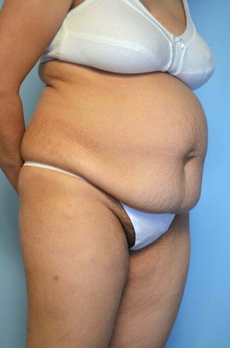Tummy Tuck Before & After Gallery - Patient 239638 - Image 3