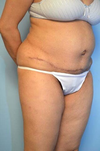 Tummy Tuck Before & After Gallery - Patient 239638 - Image 4