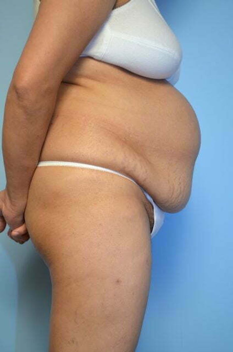 Tummy Tuck Before & After Gallery - Patient 239638 - Image 5