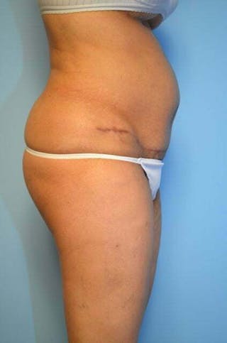 Tummy Tuck Before & After Gallery - Patient 239638 - Image 6