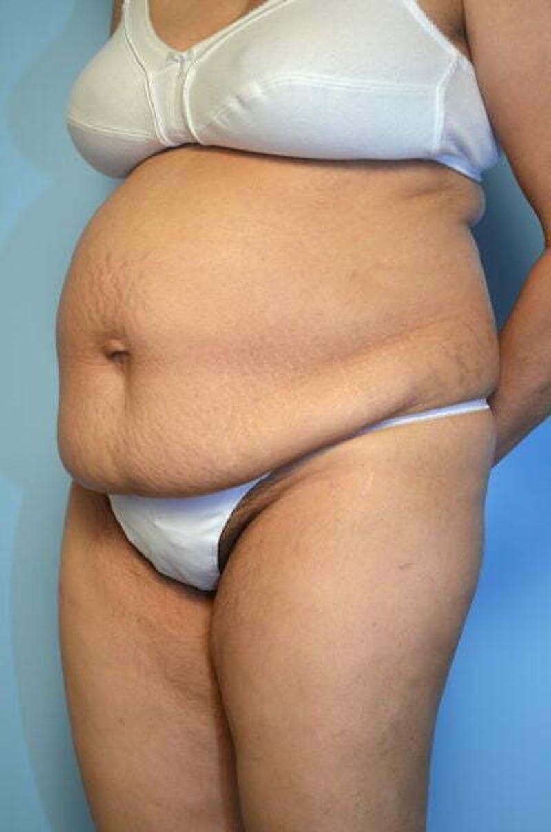 Tummy Tuck Before & After Gallery - Patient 239638 - Image 7