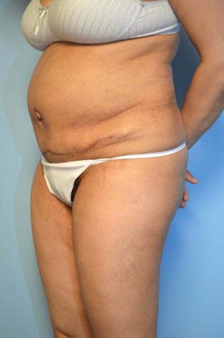 Tummy Tuck Before & After Gallery - Patient 239638 - Image 8