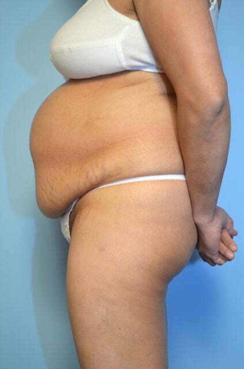 Tummy Tuck Before & After Gallery - Patient 239638 - Image 9