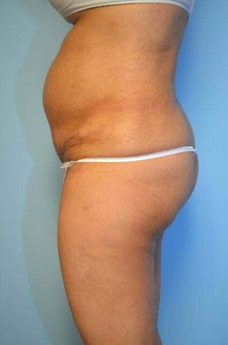 Tummy Tuck Before & After Gallery - Patient 239638 - Image 10